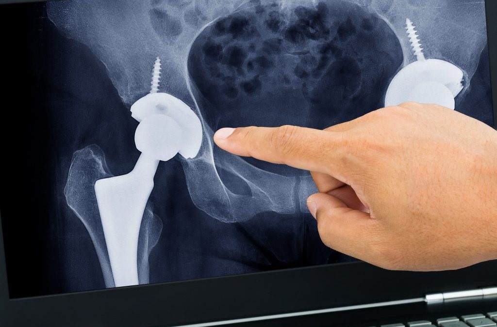 Hip Replacement Surgery: Everything You Need To Know