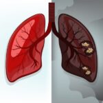 Medication Combination Help Shrink Tumors In Lung Cancer