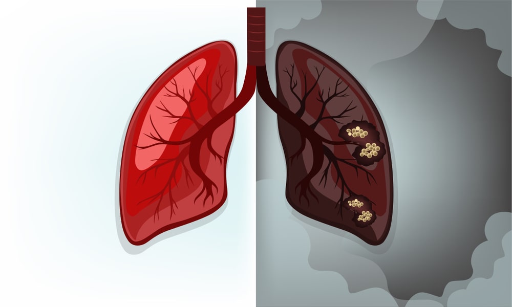 Medication Combination Help Shrink Tumors In Lung Cancer
