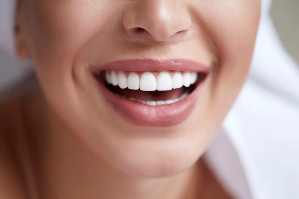 The Lifespace of Dental Veneers: What to Expect and How to Extend It