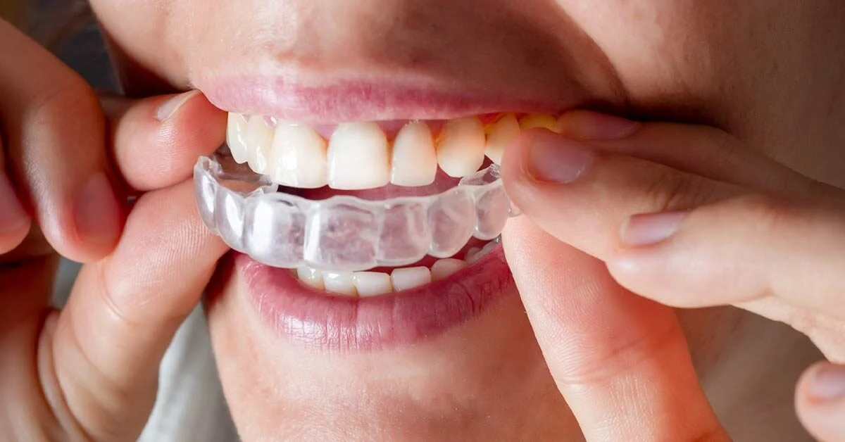 How to Care for Your Teeth if You Wear Invisalign