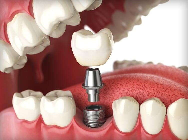 4 Dental Cosmetic Enhancements That Pair Well With Dental Implants