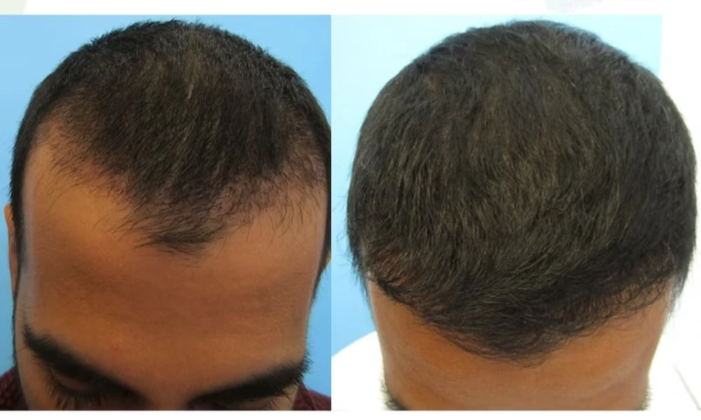 Can PRP Injections Reverse Early Stage Hair Thinning and Loss?