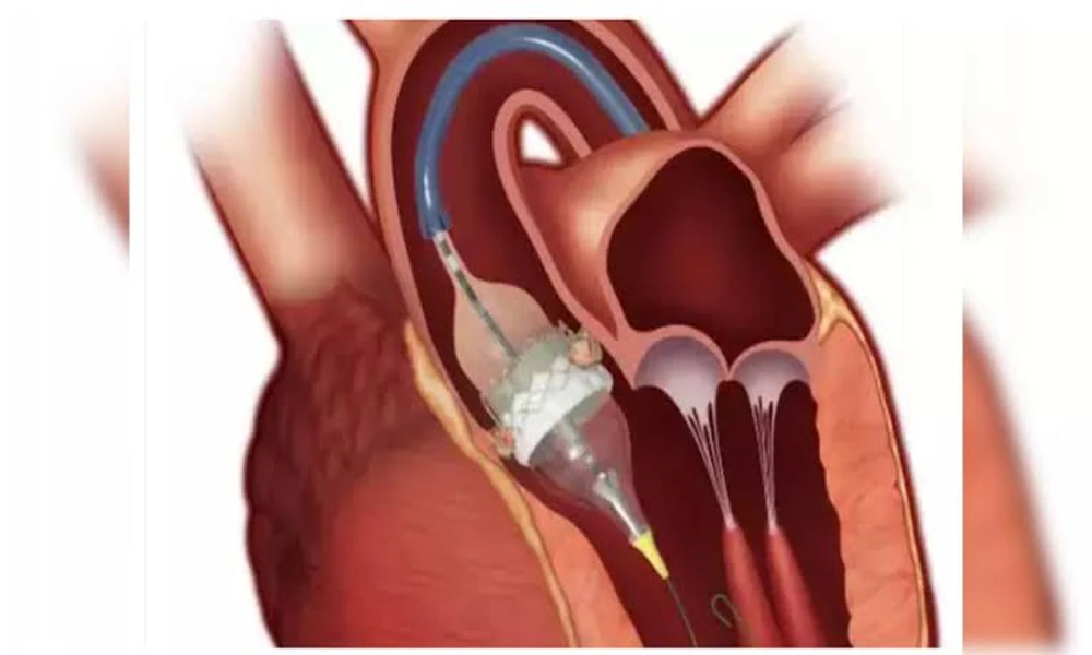TAVI Recovery Guide: What Patients Can Expect After the Procedure